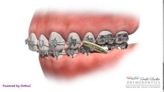 Elastics  Class II  Orthodontic Treatment [upl. by Hobey]