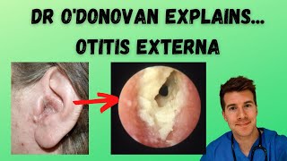 Explaining Otitis Externa  With Dr ODonovan [upl. by Donia]