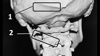 What is Occiptial Neuralgia [upl. by Cawley]