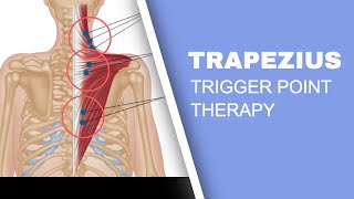 Trapezius Trigger Points and Headaches [upl. by Oinotla]