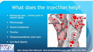 Overview of Trigger Point Injections Explained by a NJ Pain Clinic [upl. by Siberson833]