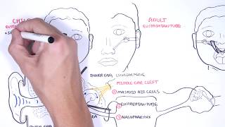 Acute Otitis Media Causes Pathophysiology signs and symptoms treatment and complications [upl. by Heffron]