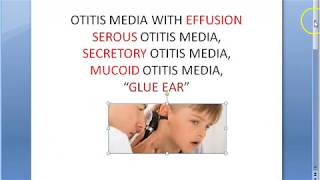 ENT Glue Ear Ottitis Media With Effusion Child Serous Secretory Mucoid [upl. by Deer]