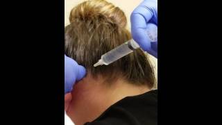 Bilateral Occipital Nerve Block [upl. by Wj]