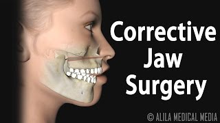 Corrective Jaw Orthognathic Surgery Animation [upl. by Lussier140]