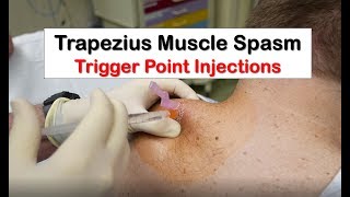 Trapezius Muscle Spasm Trigger Point Injection [upl. by Barboza]