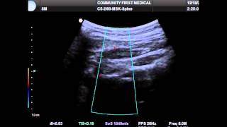 Ultrasound Guided Occipital Nerve Block [upl. by Nadabas]