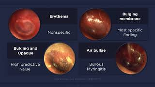 Acute Otitis Media Otoscopic Findings [upl. by Antonin]