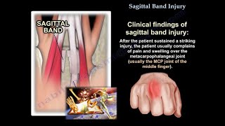 Sagittal Band Injury  Everything You Need To Know  Dr Nabil Ebraheim [upl. by Niwle]